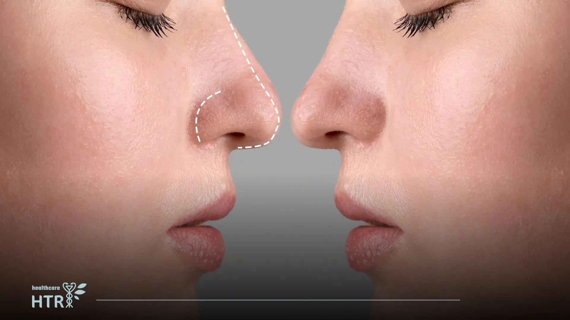 Rhinoplasty: A Surgical Solution for Enhancing Your Nose Shape