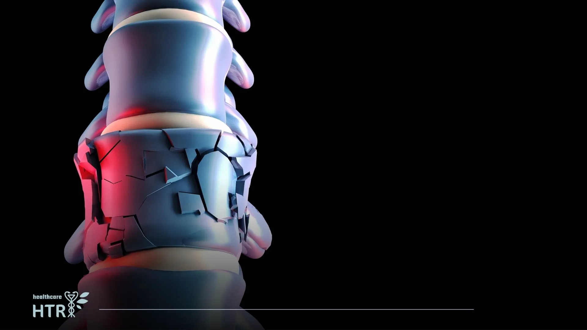 Say Goodbye to Chronic Pain with Spinal Cord Stimulation Surgery